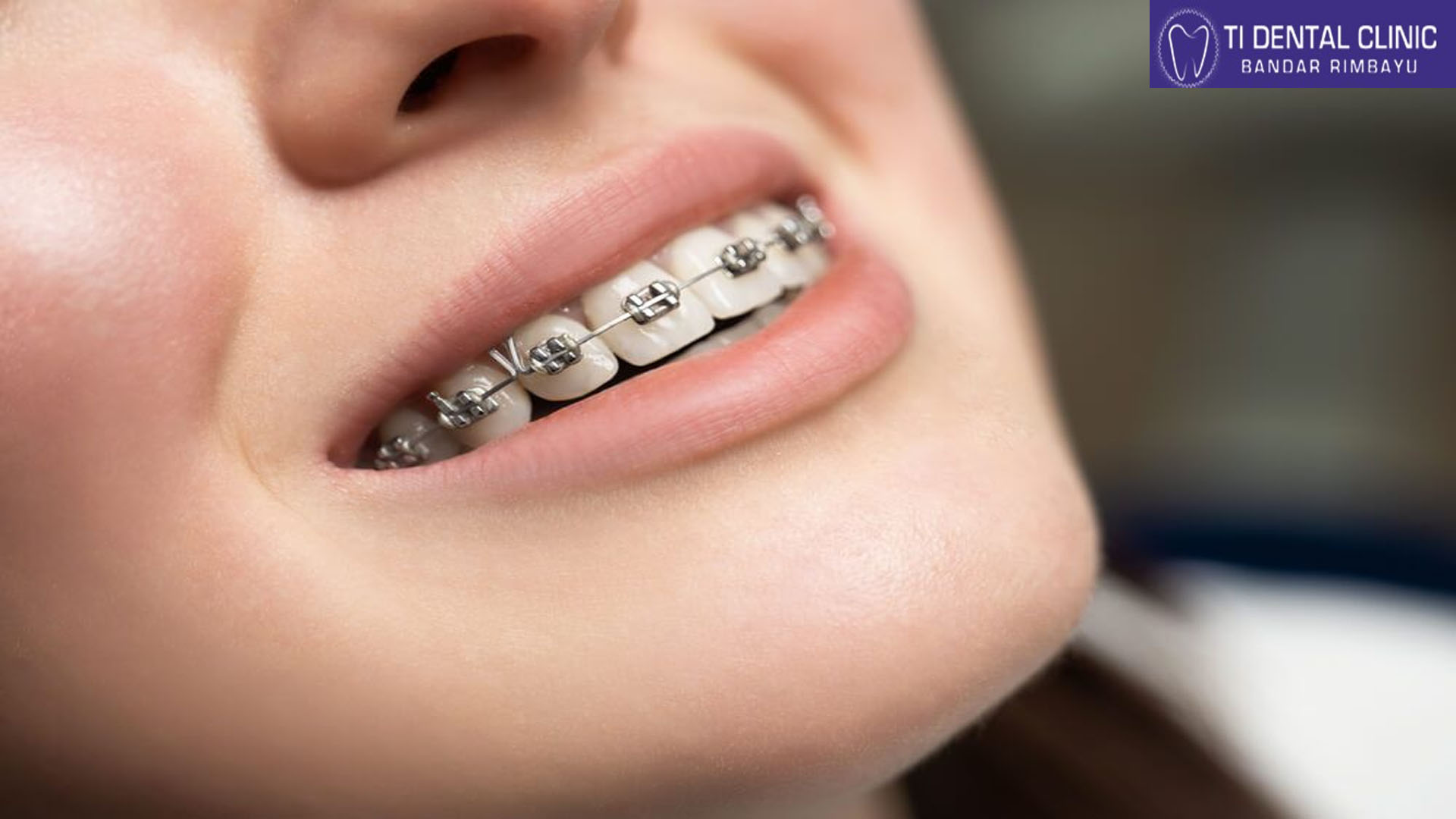 Dental Braces Aftercare: Maintaining Your New Smile